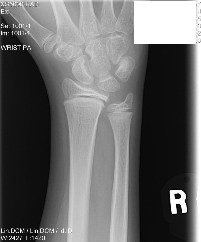 Broken growth plate in wrist doctorvisit